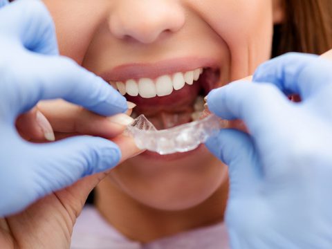 ortodonzia invisibile bambini